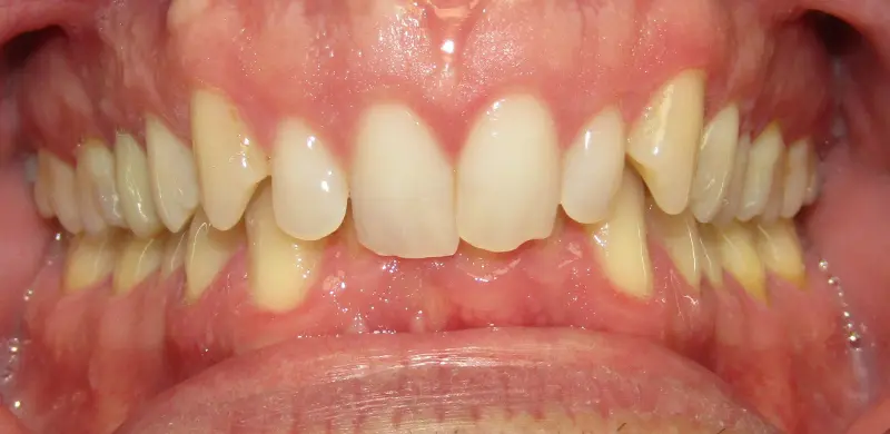 Before Aligners