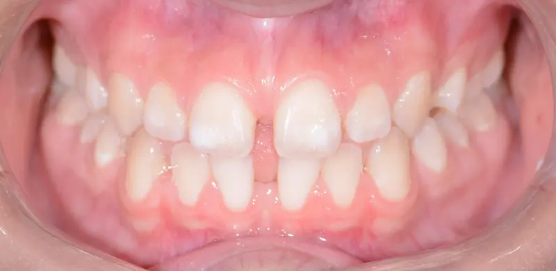 Before Aligners