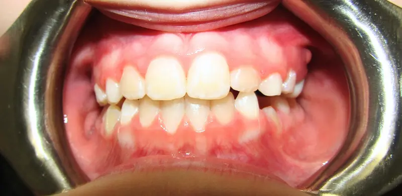 Rafaella center Before