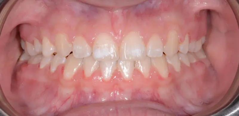After Aligners
