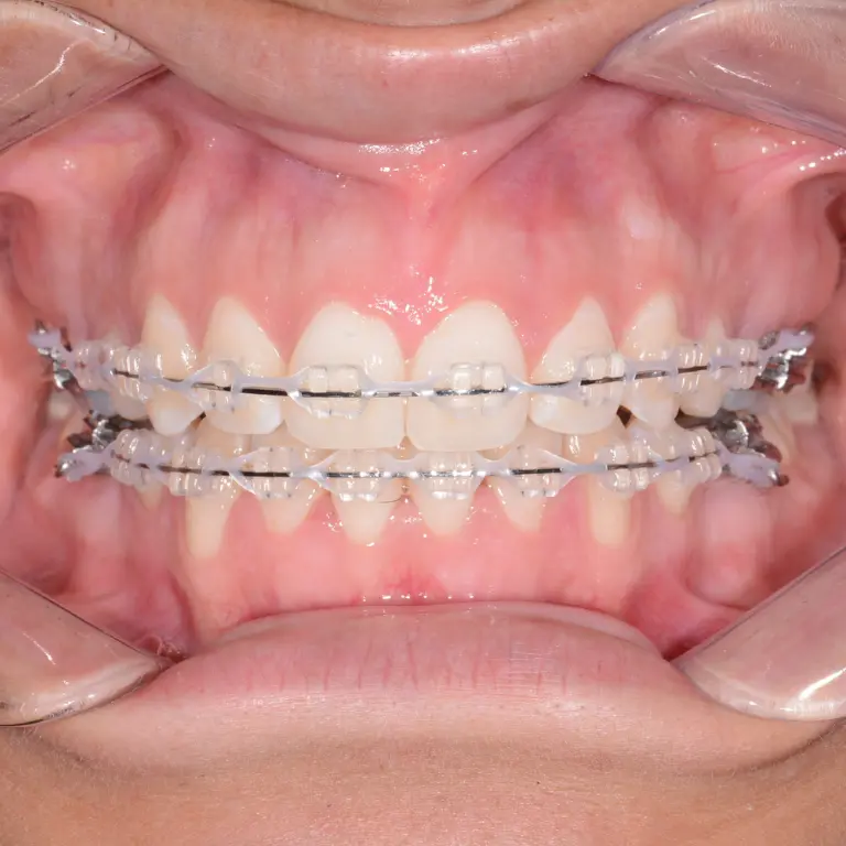 Ceramic Braces