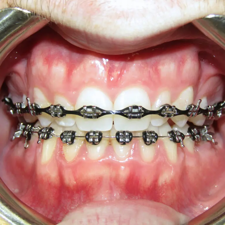 Metal Braces