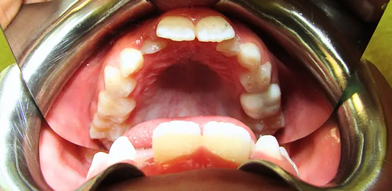 Rafaella center Before