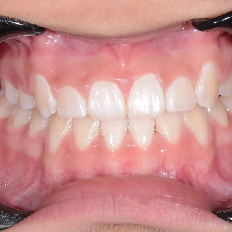 Clear Aligners